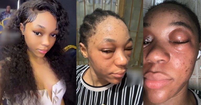 "na alcoh0l give you gbas gbos for eye" -Netizens React As Lady Shares her Startling Allergic Reaction to Alcoh0l (VIDEO)