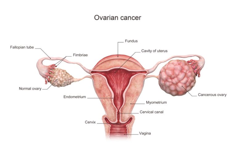 Seven essential tips to prevent ovarian cancer