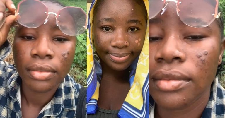 "Love conquǝrs all" – Nigerian lady jubilates after she nearly lost one eye while frying plantain for boyfriend (WATCH)