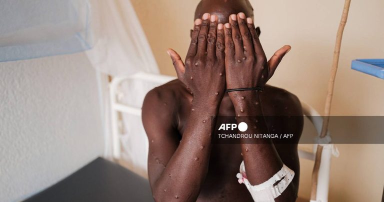 Mpox patient describes agony as Burundi battles outbreak