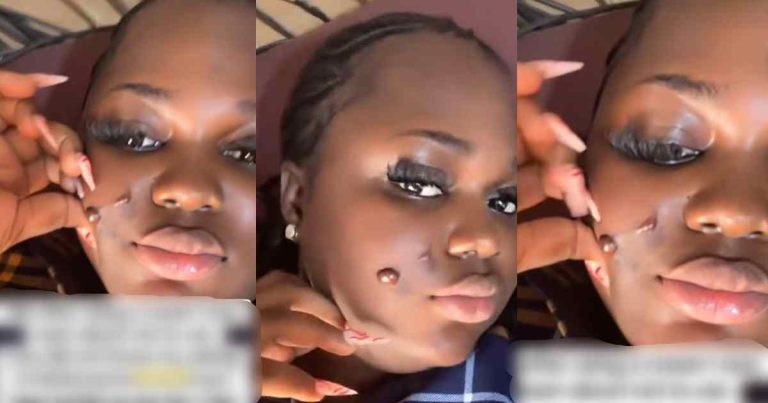 "I have keloid on my face that has to be operated on" – Lady ign0res a skin care warn!ng, gets keloid infect!on on face (VIDEO)