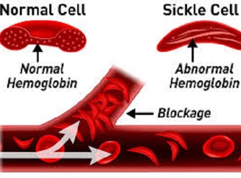 sickle cell health