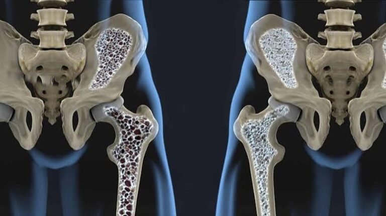 Fragility fractures, major consequence of osteoporosis, says orthopaedic surgeon