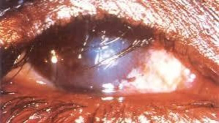 Nigeria nears trachoma elimination, with only 11 LGAs left — FG Nigeria nears trachoma elimination, with only 11 LGAs left — FG