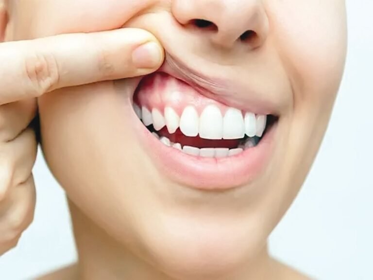 Gum infection