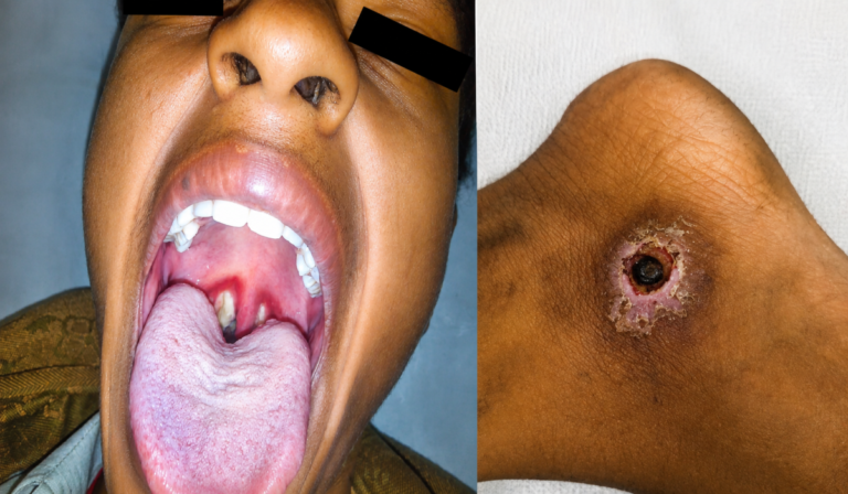Taraba: Confusion over diphtheria cases as health officials give conflicting figures Taraba: Confusion over diphtheria cases as health officials give conflicting figures